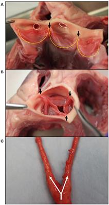 Comparing the Role of Mechanical Forces in Vascular and Valvular Calcification Progression